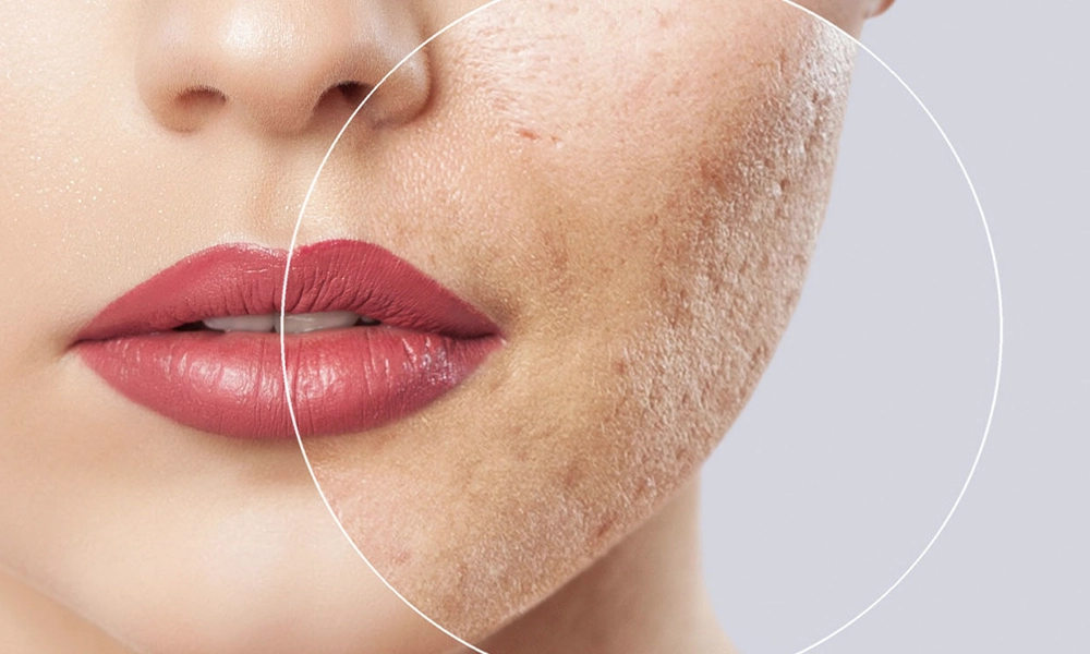 فررورفتگی پوست در ناحیه گونه