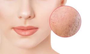 فررورفتگی پوست صورت از نمای نزدیک