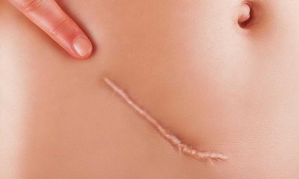 عکس جای زخم روی شکم و زیر ناف