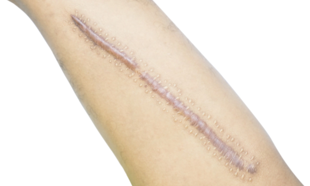 جای زخم عمیق و بلند روی ساعد دست