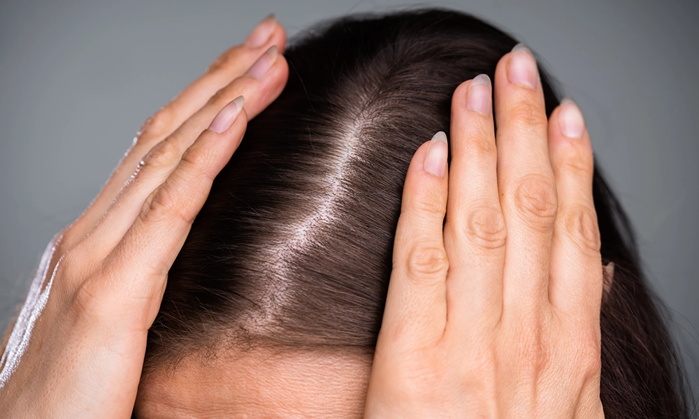 نازک شدن مو و نمایان شدن کف سر