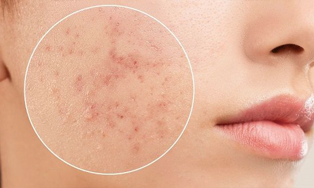 فررورفتگی پوست