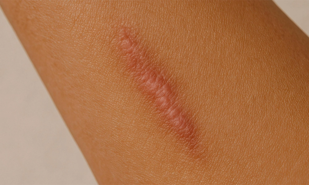 جای زخم قدیمی و کهنه