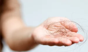 ریزش مو روی دست