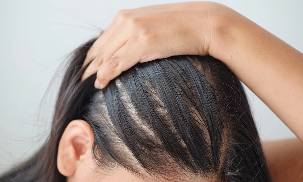 نازک شدن مو یک خانم