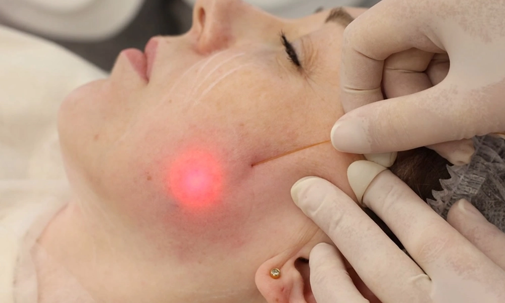 انجام اندولیفت روی زاویه فک و گونه