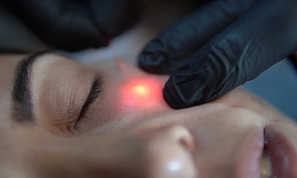 انجام اندولیفت برای گونه و زیر چشم یک خانم