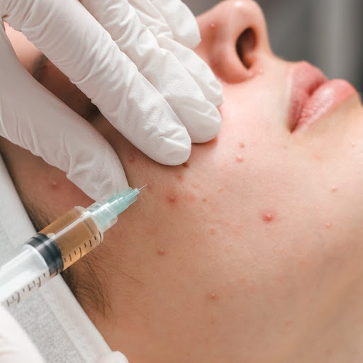 Facial acne treatment