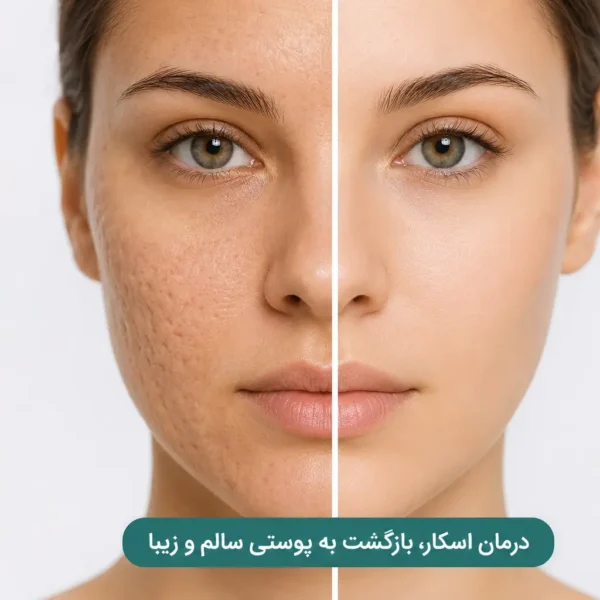 - درمان جای جوش درمان اسکار