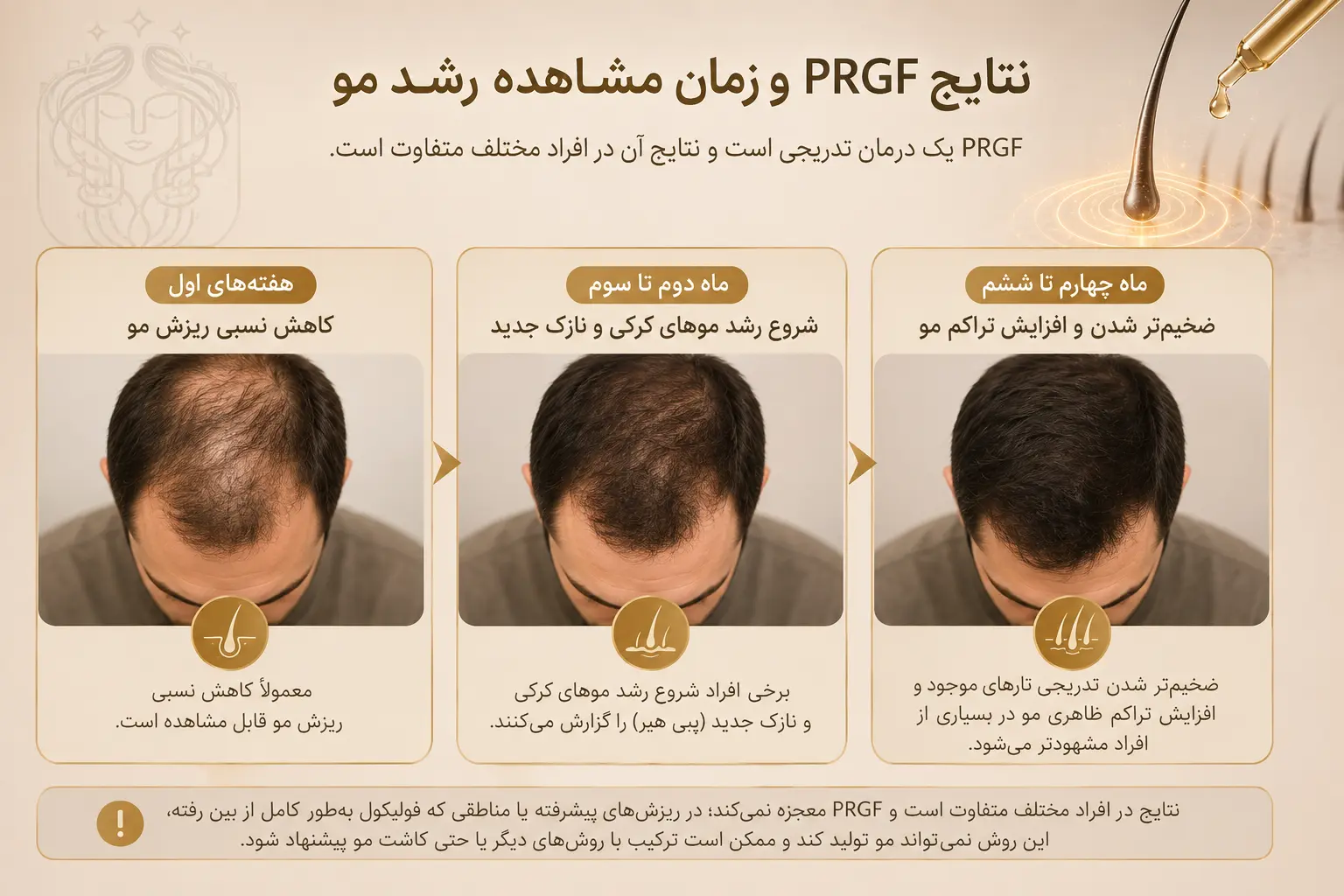 تقویت مو به روش PRGF