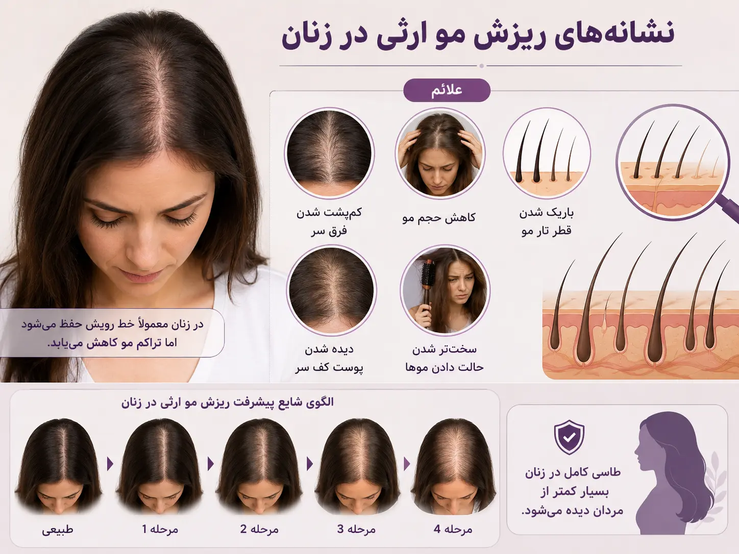 ریزش مو ارثی در زنان