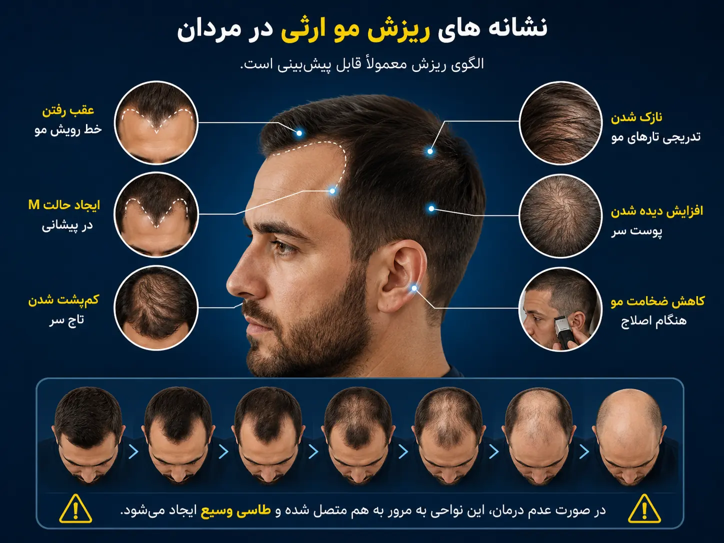 ریزش موی ارثی در مردان