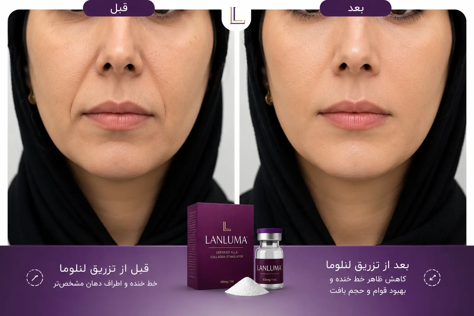لنلوما برای خط خنده و اطراف دهان