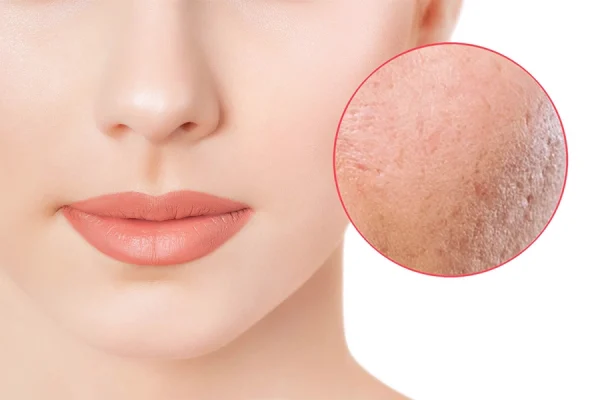 فررورفتگی پوست صورت از نمای نزدیک