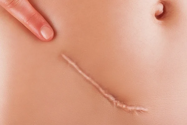 عکس جای زخم روی شکم و زیر ناف