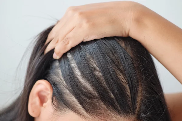 نازک شدن مو یک خانم